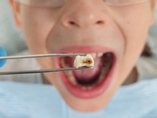 Best Broken or Chipped Tooth Repair in Minier, IL